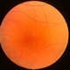 Idiopathic Central Serous Choroidopathy